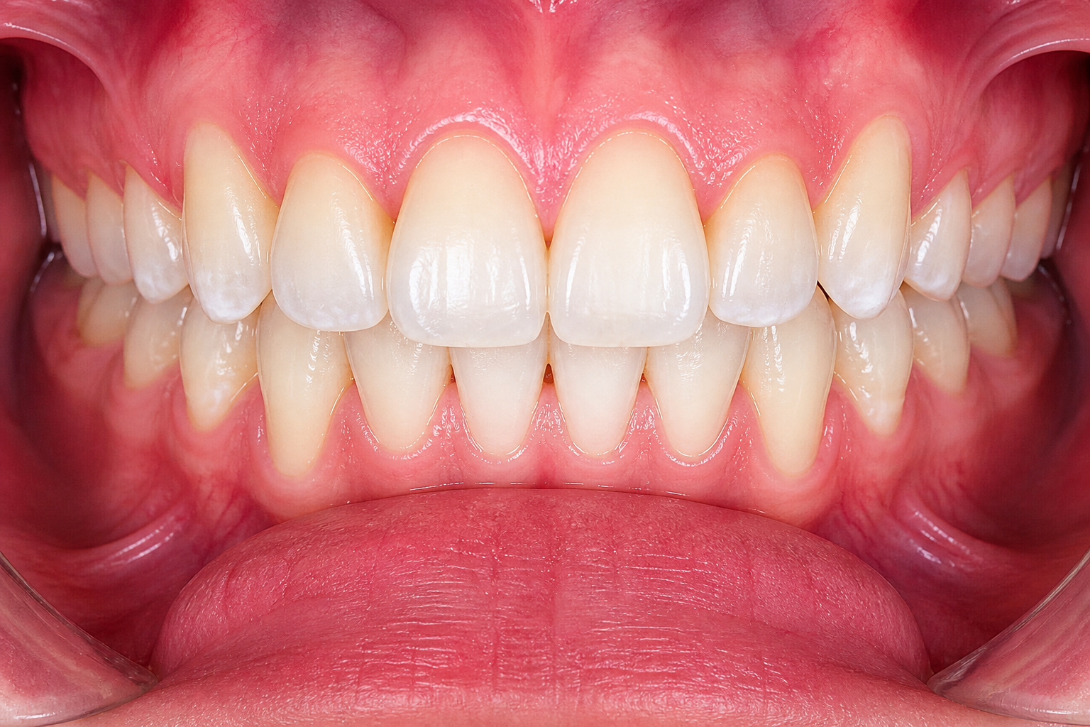 Self-Ligating braces - After